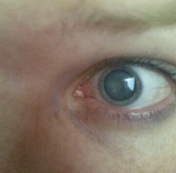 Cloudy lens in eye with cataract